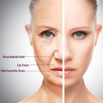 Dermalfillers